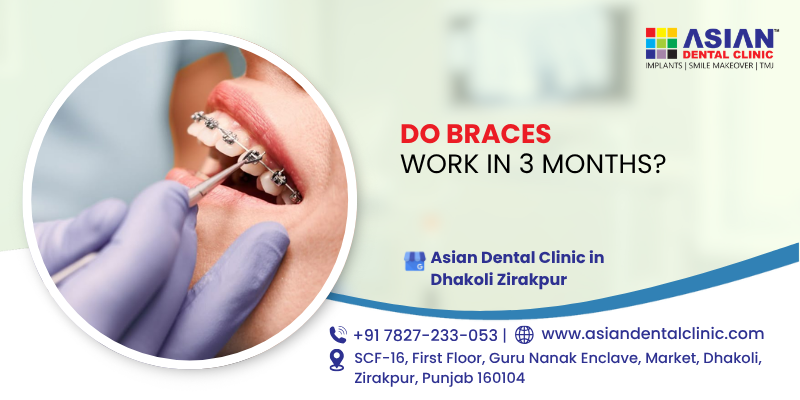 Do braces work in 3 months?
