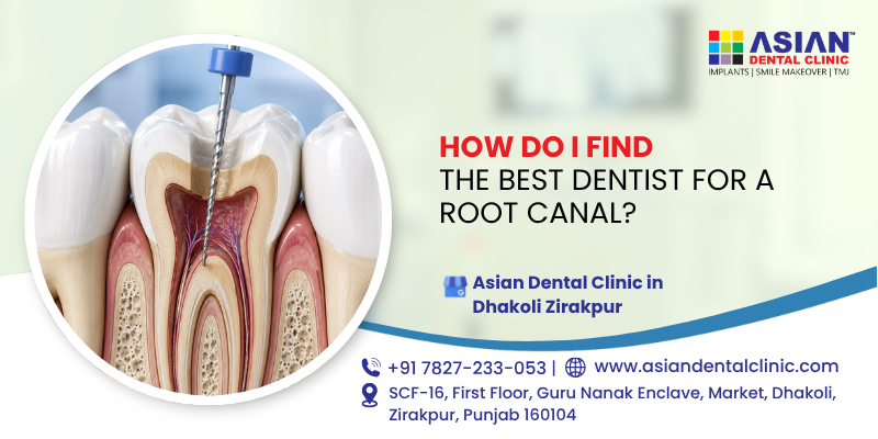 How do I find the best dentist for a root canal?