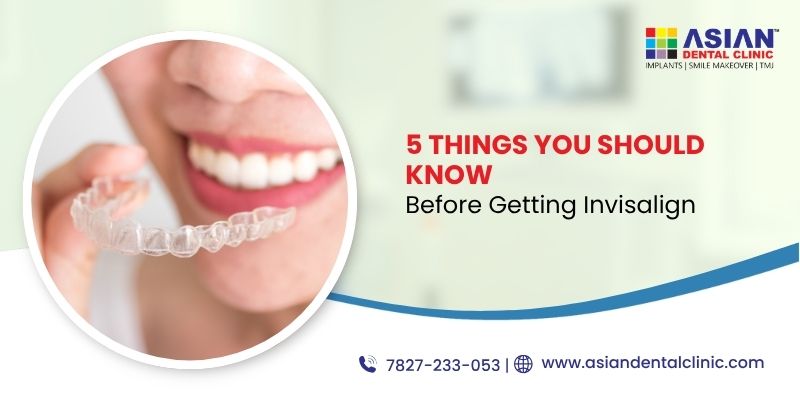 5 Things You Should Know Before Getting Invisalign