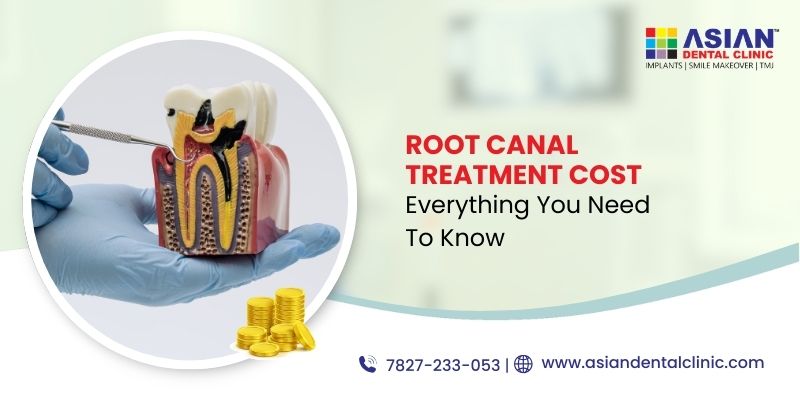 Root Canal Treatment Cost: Everything You Need to Know
